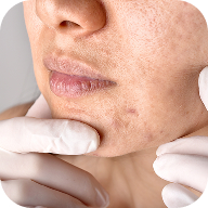 Trattamento di alcune condizioni dermatologiche: psoriasi e acne