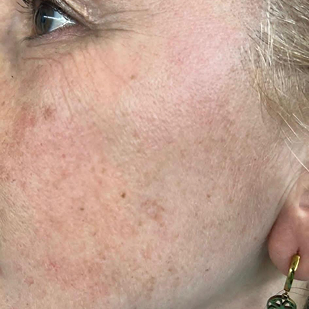 Rivitalizzazione del viso con ozono e ossigeno Prima